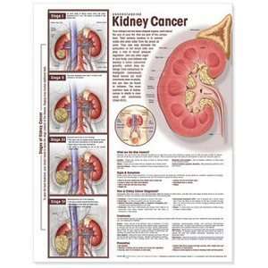 Understanding Kidney Cancer Anatomy Chart/Poster  