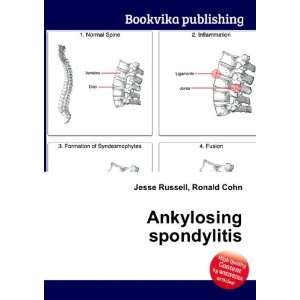  Ankylosing spondylitis Ronald Cohn Jesse Russell Books